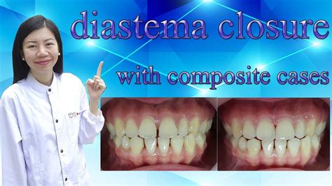 Diastema Closure With Composite Cases Youtube