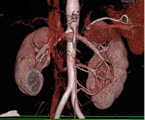 Duplicated Collecting System Left Kidney With An Incidental Left 1 Cm