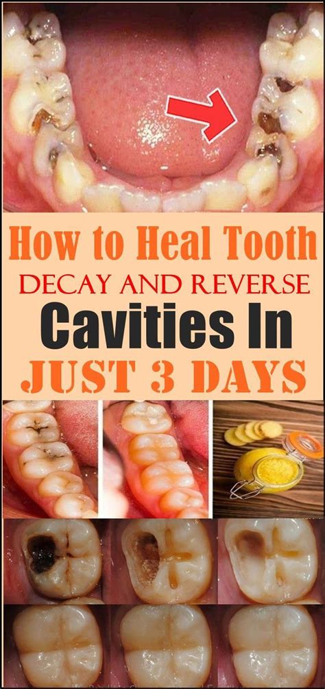 Is it possible to reverse tooth decay by brushing, or eating certain foods? body remedy in 2020 | Reverse cavities, Tooth decay ...