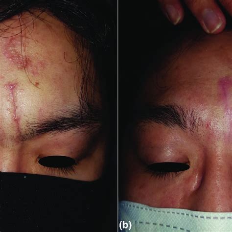 Patients Clinical Features Clinical Pictures Of Acne Atrophic Scars