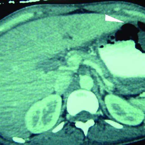 Síndrome clínico grave frecuente en pacientes con acidosis y diabetes mellitus. Hifas ramificadas no septadas en ángulo recto, secundarias ...