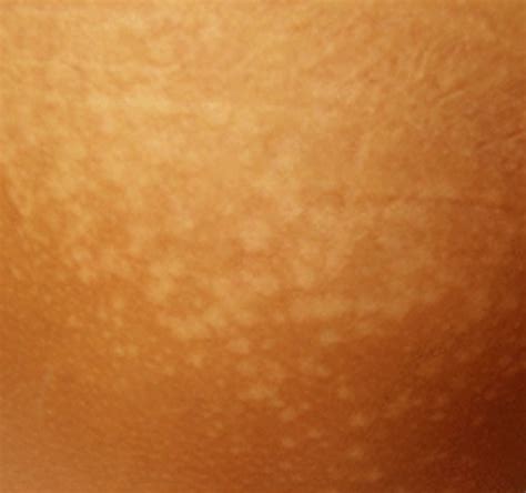 👉 Tinea Versicolor Pictures Contagious Symptoms Treatment
