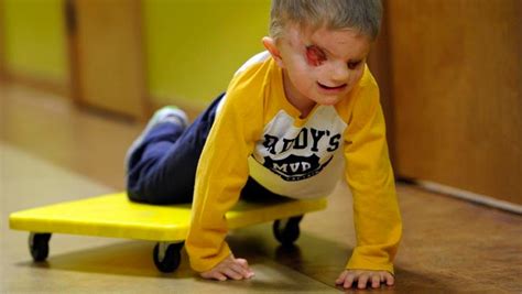 4 Year Olds Rare Birth Defect Inspires Blinding Love