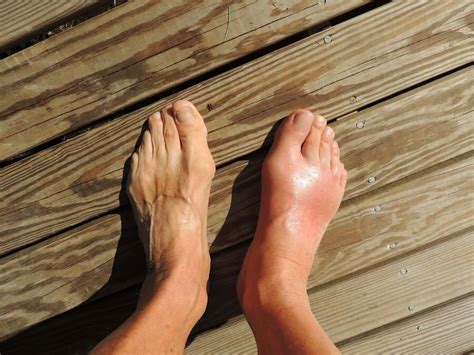 Gout Swollen Foot Can You Get Gout In The Whole Foot Your Gout Friend