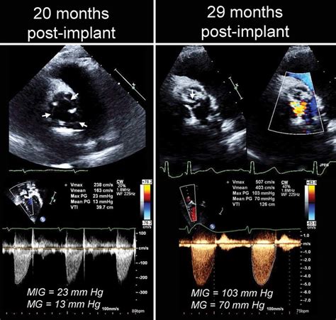 Parasternal Short Axis View Of Prosthetic Aortic Valve In Systole