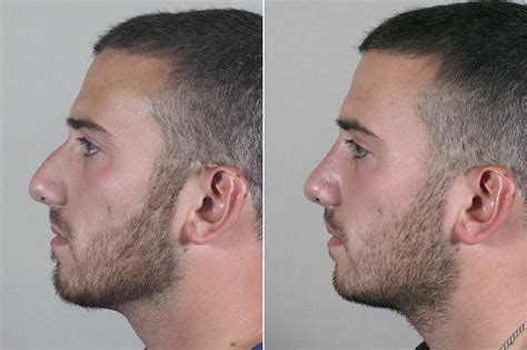 In this surgery, the ent doctor removes the extra cartilage from the deviated nasal septum under the influence of anesthesia. Male Rhinoplasty Patient 13 - Parker Center for Plastic ...