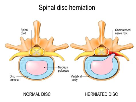 Lower Back Pain And The Herniated Disc