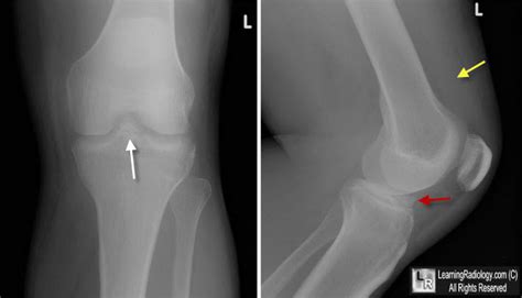 Discussion fracture of the tibial spine is an unusual injury, with an incidence estimated at 3: Learning Radiology - avulsion, fracture, anterior, tibial ...