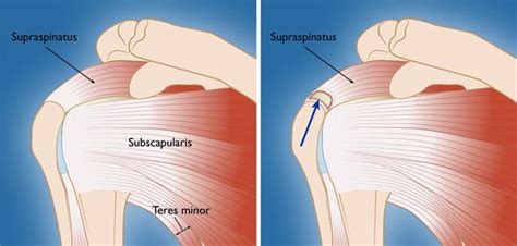 Rotator Cuff Tears Orthoinfo Aaos