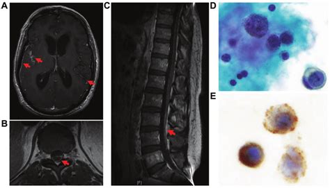 Imaging And Csf Pathology Revealed Plm With Csf Involvement A Mri Of