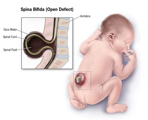 Umbilical Cord Patch Effective In Fetal Spina Bifida Repair