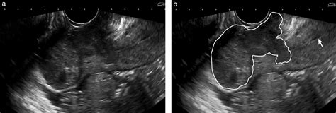Early‐stage Cervical Cancer Agreement Between Ultrasound And