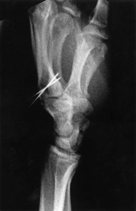 Avulsion Fracture Of The Extensor Carpi Radialis Longus In A Rugby