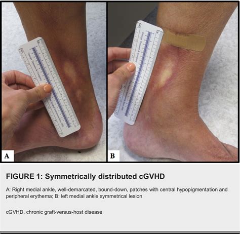 Figure 1 From Cutaneous Chronic Graft Versus Host Disease In A