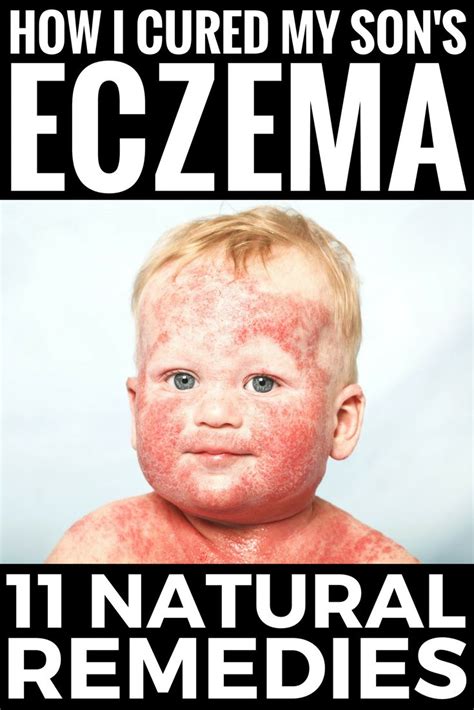 The term is derived from the greek roots spondylo, meaning spine, and listhesis, meaning to slide down a slippery path. How I cured my son's eczema. If one or more of your ...