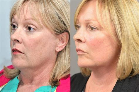 facial rejuvenation before and after patient 06 marotta plastic surgery specialists