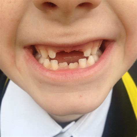 Do the same tooth and gum exam on the front teeth and again on the other side of the mouth. Child with no front teeth - License, download or print for ...