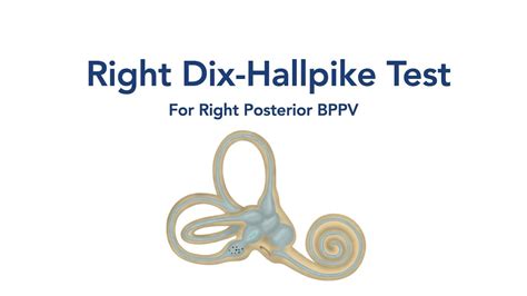 At Home Right Dix Hallpike Test For Bppv Vertigo Youtube