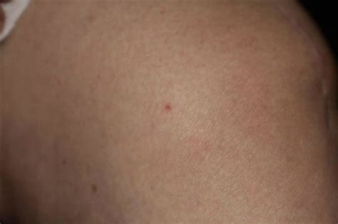 Bedbug Bites On Foot Econo Lodge Lemon Grovebedbug Bites On Ankle Econo