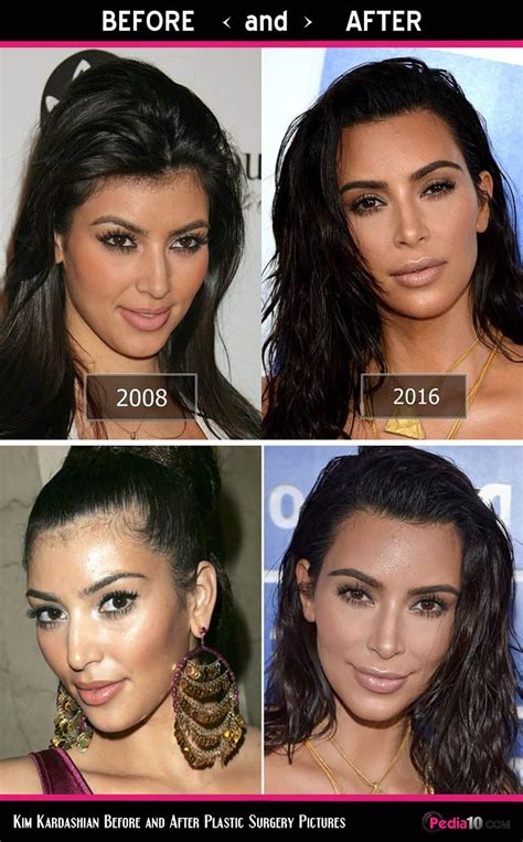 Kim Kardashian Face Pics Plastic Surgery Before And After Photo
