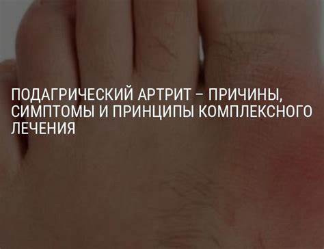Подагрический артрит – симптомы, принципы медикаментозного лечения Картинка - Подагрический артрит – симптомы, принципы медикаментозного лечения