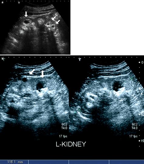 Cystic Diseases Of The Kidney Radiology Key