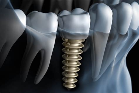 📍 Cómo Es El Proceso De Colocación De Un Implante Dental Paso A Paso