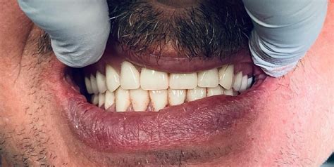 Happy Patients Desoto Dentures And Implants Southaven Ms