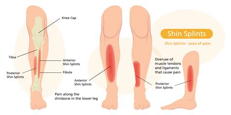 Amazing Info About How To Prevent A Shin Splint Stopsalt