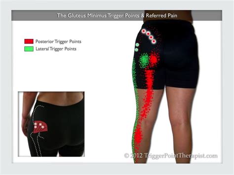 How to perform a glute stretch with perfect form. Diagram of the gluteus minimus trigger points and referred pain | Pain Relief/ Exercises ...