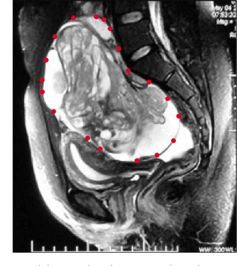 Figure From Growing Teratoma Syndrome In A Post Laparoscopic Excision