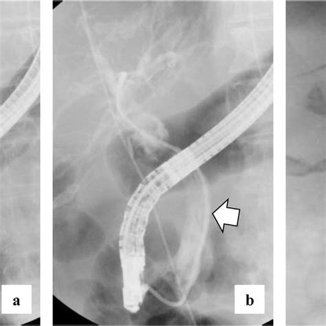 Ercp Findings There Is No Leakage Of Contrast Medium Outside The Cbd
