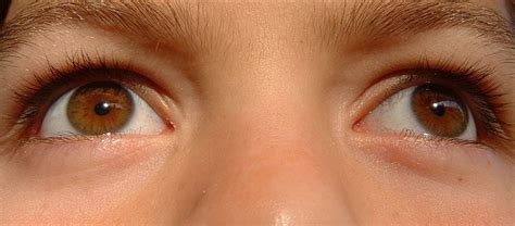 Hazel Eyes Are Often A Manifestation Of Central Heterochromia As