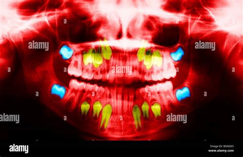 Child Tooth X Ray Stock Photo Alamy
