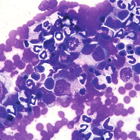 Bone Marrow Cytological Photomicrograph Showing Blastic Cells With