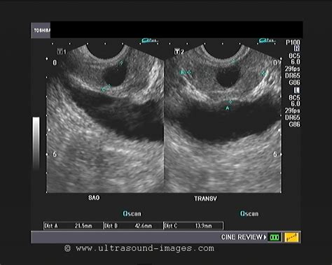 Prostate Size Transabdominal Ultrasound Results