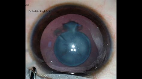 Lens Aspiration In A Zonular Cataract Part 1 Unedited Hd Youtube
