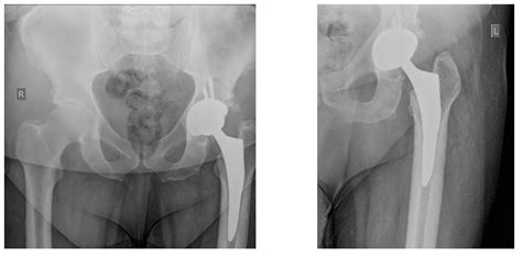 Total Hip Replacement Case Study Free Case Study With Photos
