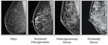 Cancer causes cells to divide uncontrollably. Both Doctors and Patients Confused by Dense Breasts ...