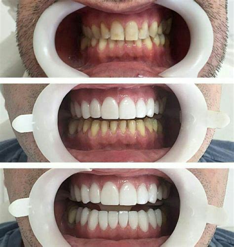 Porcelain veneers are more expensive than the indirect or direct composite. DENTAL VENEERS: How much do veneers cost in Nigeria? - Nigerian Health Blog