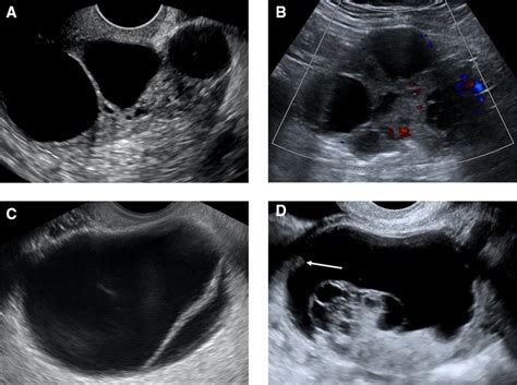 Ultrasound Examples Of O Rads Lexicon A Grayscale Image Of An Ovarian