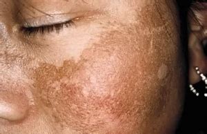 Ver más ideas sobre cortes de cabello corto, cabello con freja.everything about her in this picture is stunning! ¿Cuánto sabés del melasma o máscara del embarazo? - Vos TV
