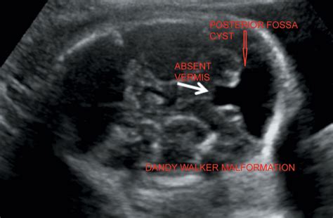 Fetal Malformations Radiology Key