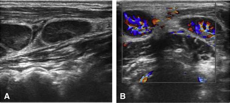 Point Of Care Ultrasound For Evaluating Lymphadenopathy In The