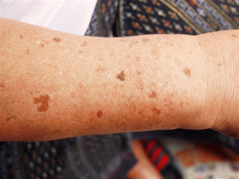 Mancha escura na pele entenda as possíveis causas Tasaudavel Saúde Tasaudavel