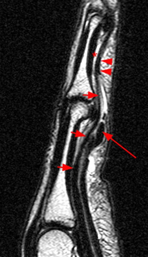 Fdp Tendon Anatomy : Flexor Tendon Anatomy Thumb Finger - Related posts