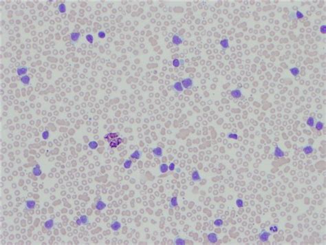 Although atl is often highly aggressive, the clinical presentation is variable and, in some cases, it is an indolent disorder. Pathology Outlines - Prolymphocytic leukemia