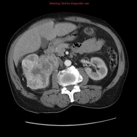 Renal Cell Carcinoma Tnm Staging Radiology Reference Article