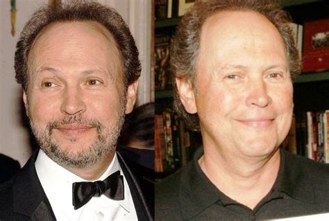 Billy Crystal Before And After Plastic Surgery 1 Celebrity Plastic