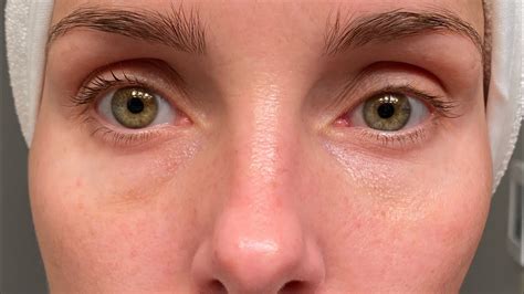 tretinoin wrinkles under eyes best reviews 2022 ineedskin